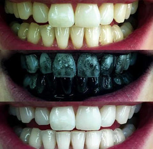 Activated Charcoal Teeth Whitening